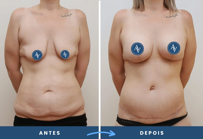 Antes e depois de mamoplastia em mulher, destacando levantamento das mamas, volume e simetria aprimorados, realizado em São Bernardo do Campo. Antes e depois de mamoplastia em mulher, destacando levantamento das mamas, volume e simetria aprimorados, realizado em São Bernardo do Campo.