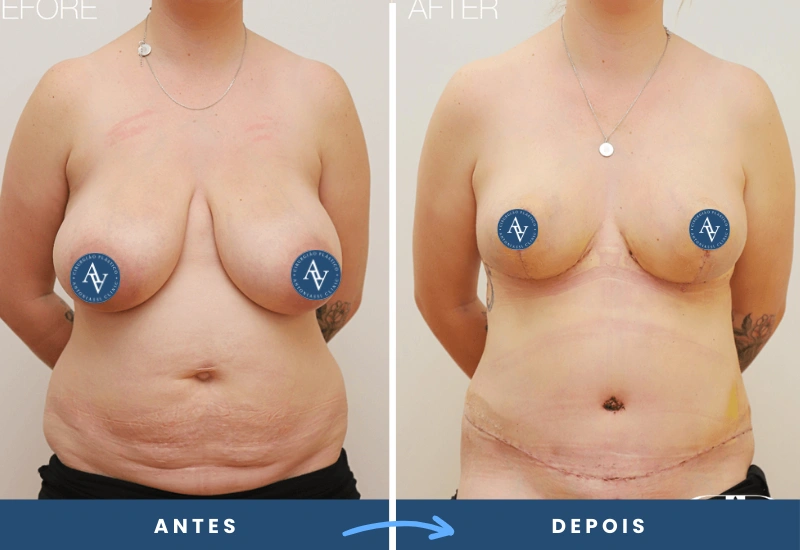 Antes e depois de mamoplastia de aumento em mulher, com mamas mais definidas e volumosas, realizado em São Bernardo do Campo. Antes e depois de mamoplastia de aumento em mulher, com mamas mais definidas e volumosas, realizado em São Bernardo do Campo.