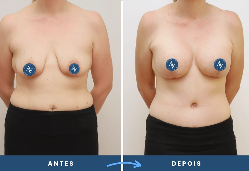 Antes e depois de mamoplastia de aumento em mulher, evidenciando proporção entre mamas e corpo, realizado por especialista em São Bernardo do Campo. Antes e depois de mamoplastia de aumento em mulher, evidenciando proporção entre mamas e corpo, realizado por especialista em São Bernardo do Campo.