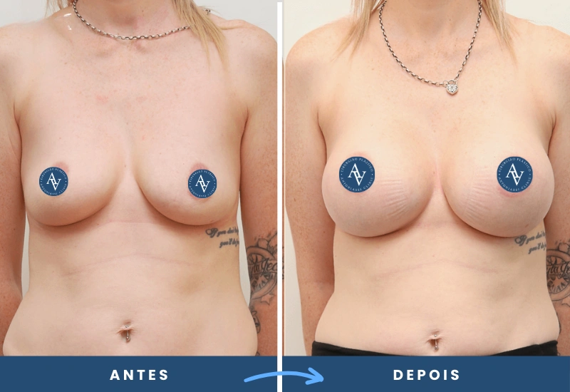 Antes e depois de mamoplastia de aumento em mulher, destacando mamas com volume equilibrado, realizado em São Bernardo do Campo. Antes e depois de mamoplastia de aumento em mulher, destacando mamas com volume equilibrado, realizado em São Bernardo do Campo.