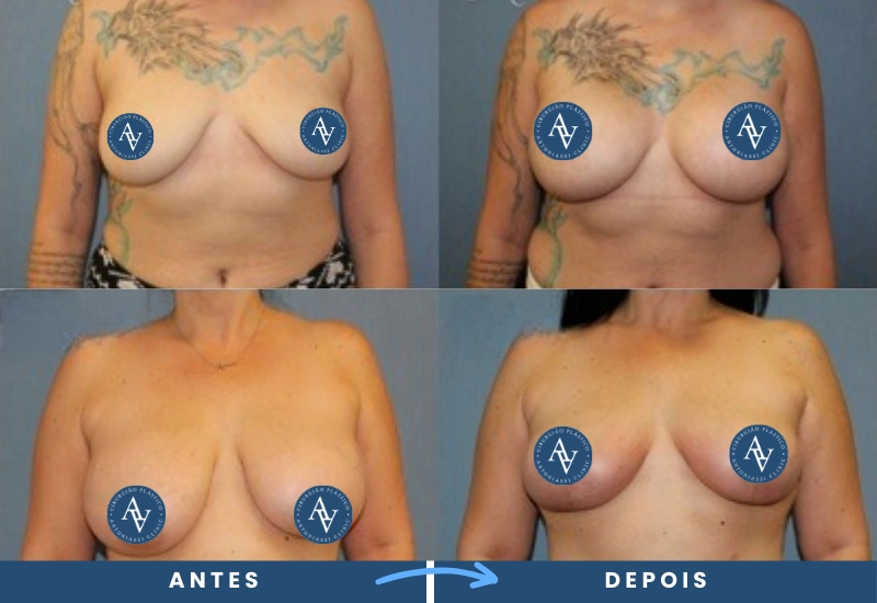 Antes e depois de mastopexia em mulher, evidenciando elevação das mamas e firmeza nos contornos, realizado em São Bernardo do Campo. Antes e depois de mastopexia em mulher, evidenciando elevação das mamas e firmeza nos contornos, realizado em São Bernardo do Campo.