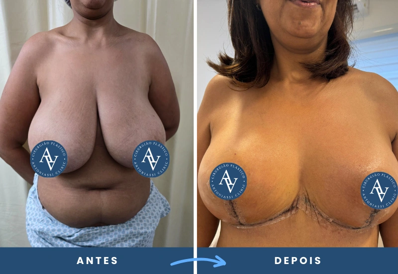 cirurgia plástica de mastopexia, conhecida como levantamento e redução das mamas, cirurgia plástica realizada em São Bernardo do Campo.