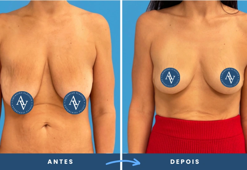 ntes e depois de mastopexia em mulher, destacando maior firmeza e contorno das mamas, realizado por especialista em São Bernardo do Campo. ntes e depois de mastopexia em mulher, destacando maior firmeza e contorno das mamas, realizado por especialista em São Bernardo do Campo.