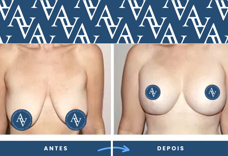 Antes e depois de mastopexia em mulher, mostrando mamas mais proporcionais e simétricas, realizado em São Bernardo do Campo. Antes e depois de mastopexia em mulher, mostrando mamas mais proporcionais e simétricas, realizado em São Bernardo do Campo.