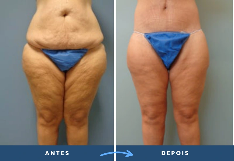 Antes e depois de lifting de coxa em mulher, evidenciando a redução de flacidez e maior firmeza nas pernas, realizado em São Bernardo do Campo. Antes e depois de lifting de coxa em mulher, evidenciando a redução de flacidez e maior firmeza nas pernas, realizado em São Bernardo do Campo.