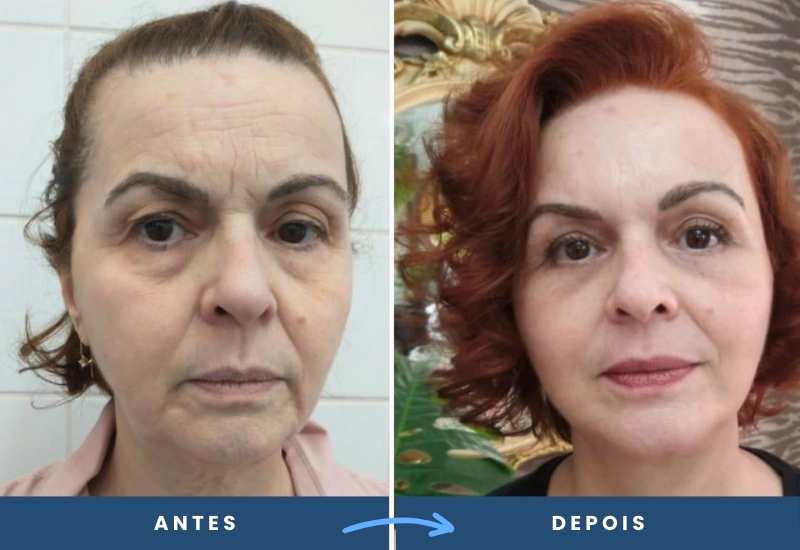 Antes e depois do mini lifting em mulher, com pele mais firme e traços faciais rejuvenescidos, resultado de cirurgia plástica em São Bernardo do Campo.