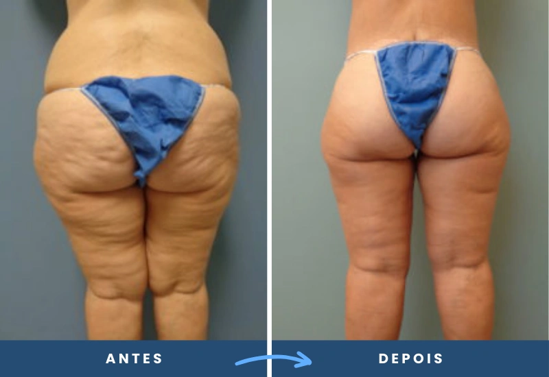 Antes e depois de lifting de coxa em mulher, destacando o contorno mais definido das coxas, realizado por cirurgião plástico em São Bernardo do Campo. Antes e depois de lifting de coxa em mulher, destacando o contorno mais definido das coxas, realizado por cirurgião plástico em São Bernardo do Campo.