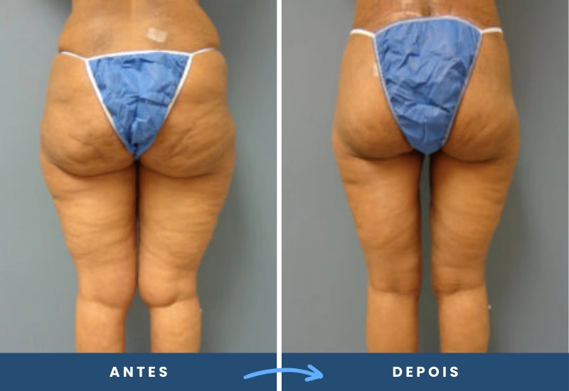 Antes e depois de lifting de coxa em mulher, com redução de flacidez e contornos remodelados, realizado em São Bernardo do Campo. Antes e depois de lifting de coxa em mulher, com redução de flacidez e contornos remodelados, realizado em São Bernardo do Campo.