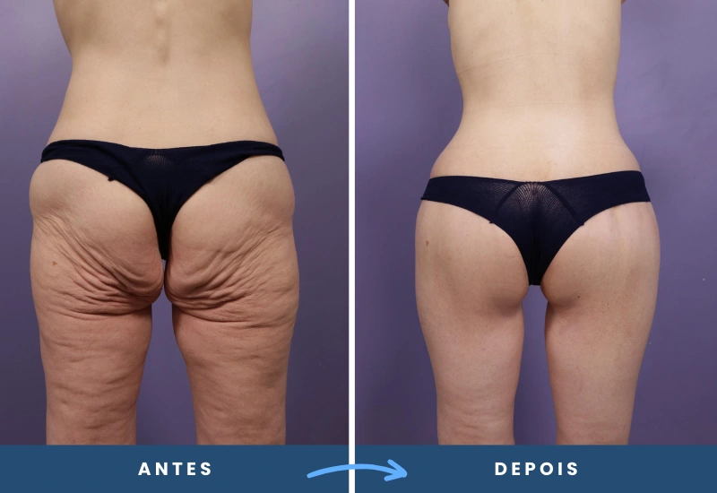 Antes e depois de lifting de coxa em mulher, mostrando resultados com coxas mais firmes e alinhadas, realizado em São Bernardo do Campo. Antes e depois de lifting de coxa em mulher, mostrando resultados com coxas mais firmes e alinhadas, realizado em São Bernardo do Campo.