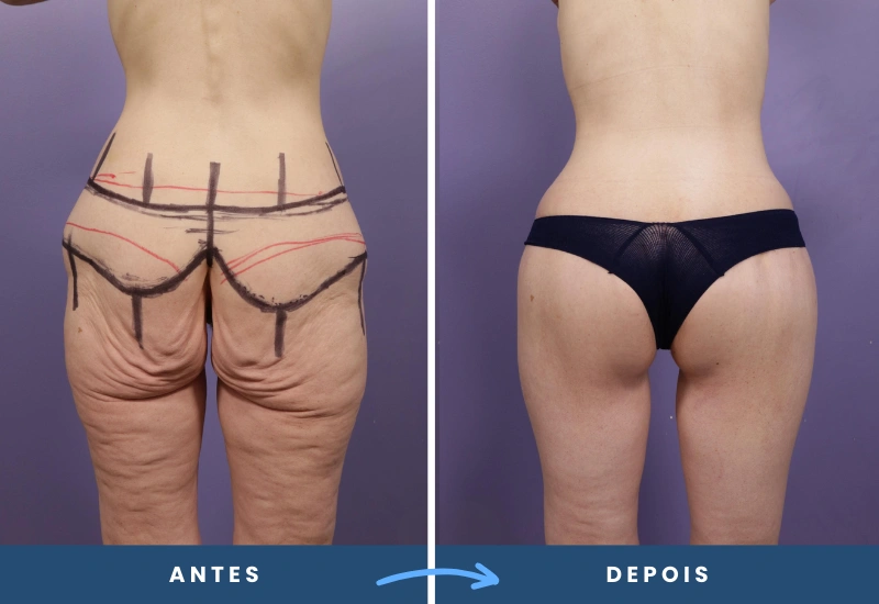 ntes e depois de lifting de coxa em mulher, evidenciando pele mais lisa e redução de excesso de tecido, realizado em São Bernardo do Campo.