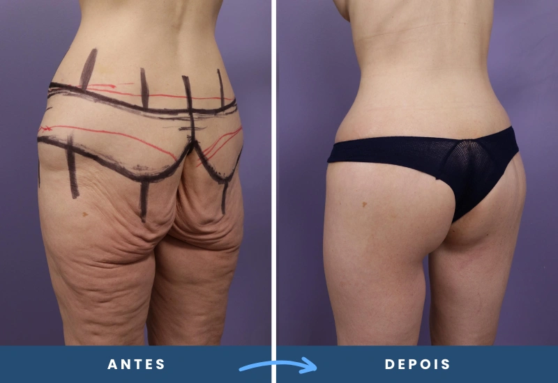 Antes e depois de lifting de coxa em mulher, com pele flácida removida e contorno mais harmonioso, realizado por especialista em São Bernardo do Campo. Antes e depois de lifting de coxa em mulher, com pele flácida removida e contorno mais harmonioso, realizado por especialista em São Bernardo do Campo.