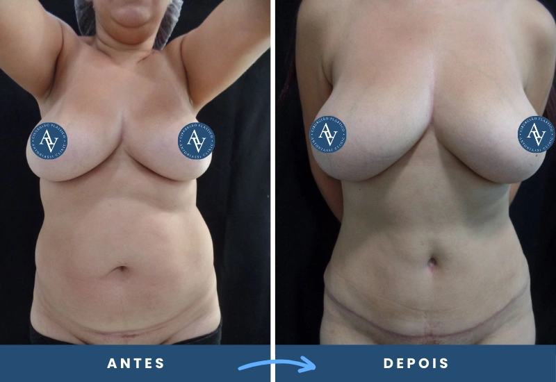 abdominoplastia, destacando a plástica do abdômen para remoção de flacidez e redefinição do contorno abdominal, realizado em São Bernardo do Campo.