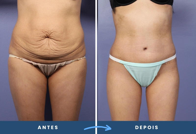 Antes e depois de abdominoplastia em mulher, destacando redução de flacidez e contornos restaurados, realizado por especialista em São Bernardo do Campo. Antes e depois de abdominoplastia em mulher, destacando redução de flacidez e contornos restaurados, realizado por especialista em São Bernardo do Campo.