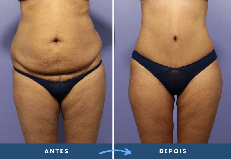Antes e depois de abdominoplastia em mulher, com abdômen remodelado e pele mais lisa, realizado em São Bernardo do Campo. Antes e depois de abdominoplastia em mulher, com abdômen remodelado e pele mais lisa, realizado em São Bernardo do Campo.