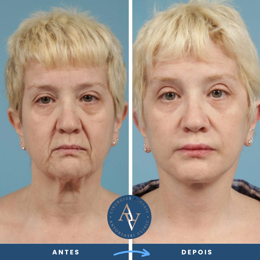 Antes e depois cirurgia facial de mini lifting facial