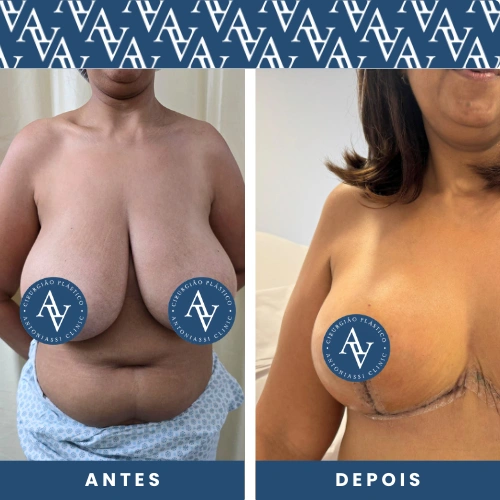 antes e depois da Cirurgias Plásticas de Mamoplastia Redutora