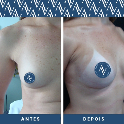 Cirurgias Plásticas de Mamoplastia de Aumento Prótese Mamária, protese de silicone, mostrando o antes e depois de uma das Cirurgias Corporais