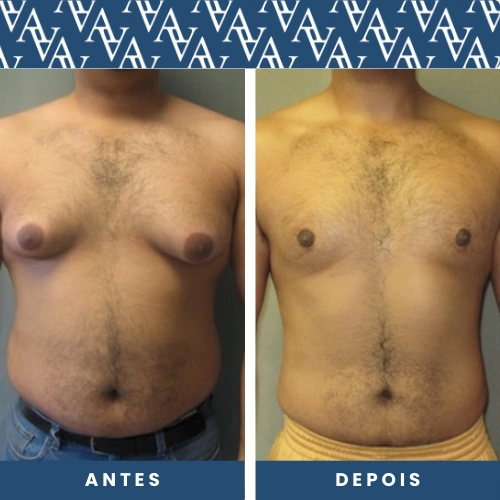 antes e depois Redução das Mamas Masculinas Ginecomastia
