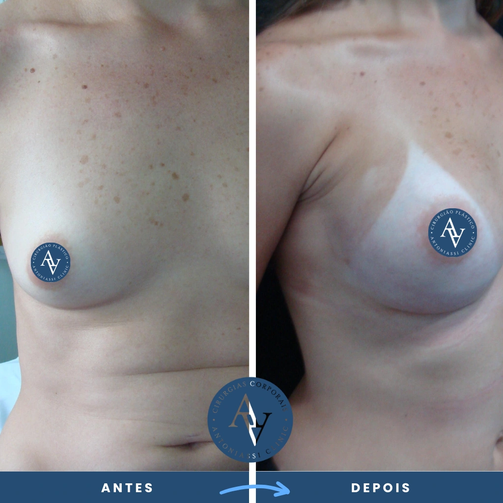 antes e depois da cirurgia corporal de mamoplastia de aumento, silicone nos seios