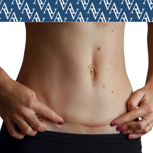 Cirurgias Plásticas de correção de cicatriz, mostrando como a cirurgia de correção de cicatriz pode ajudar