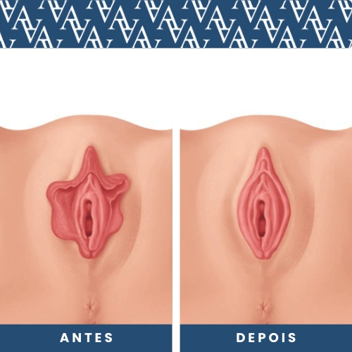desenho antes e depois partes Ninfoplastia, representando como a ginecologia estética pode mudar o visual das partes intima