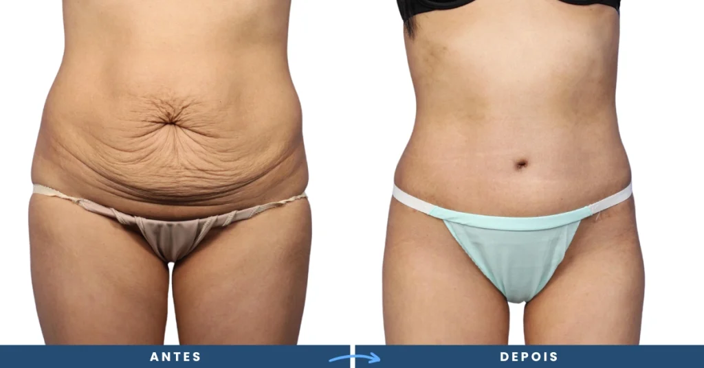 Transformação de barriga com abdominoplastia em fotos, destacando a remoção do excesso de pele e um abdômen mais definido e alinhado.