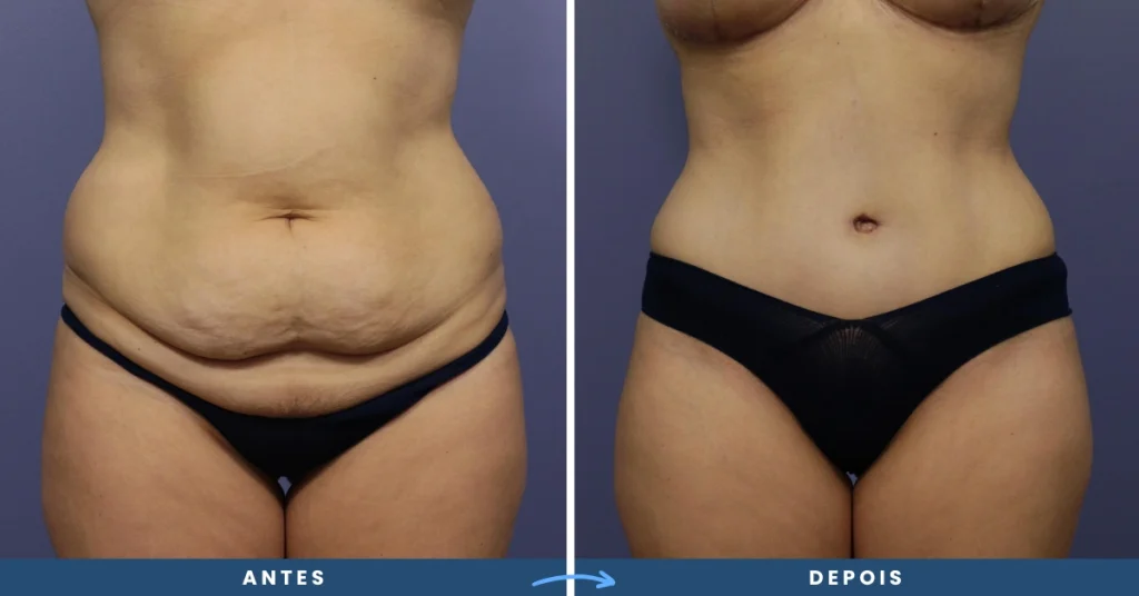 Resultado impressionante de barriga com abdominoplastia, evidenciando a eliminação de flacidez acentuada e um perfil abdominal mais harmônico.