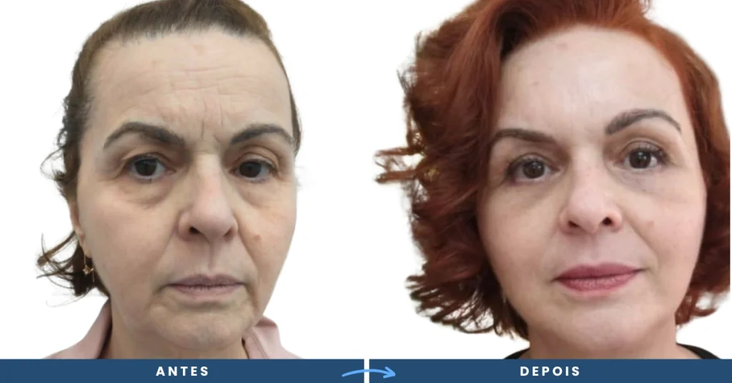 Resultado de lifting facial em fotos antes e depois, evidenciando uma transformação no contorno facial, com aparência natural e rejuvenescida.