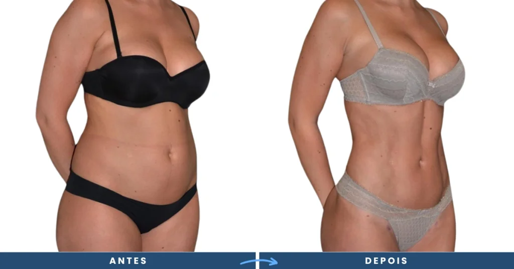 abdominoplastia antes e depois feito com Cirurgia plástica consórcio​