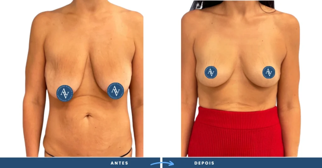 Antes e depois da Mamoplastia redutora​