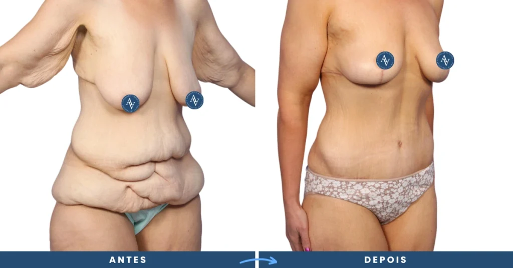 Mastopexia antes e depois