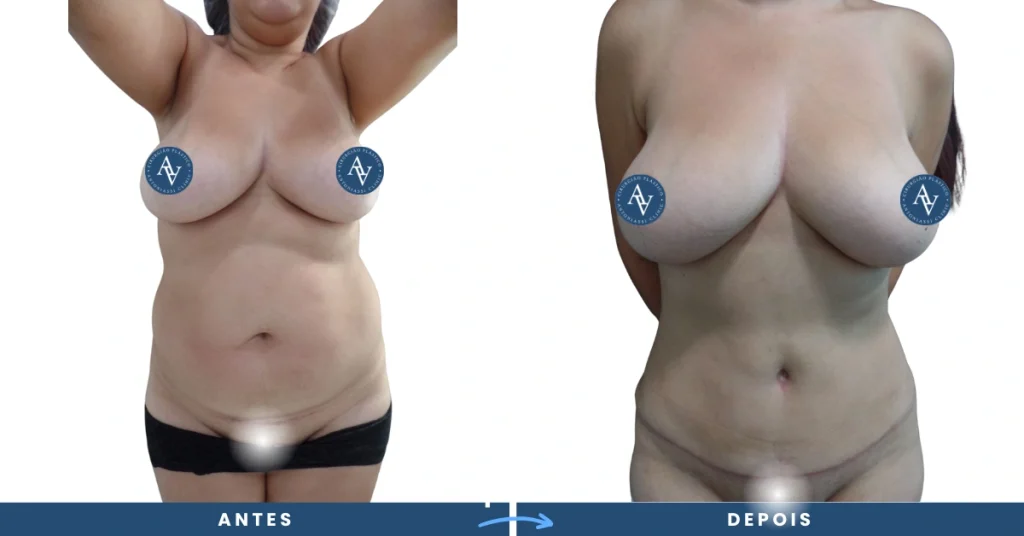 Mostrando Abdominoplastia antes e depois​