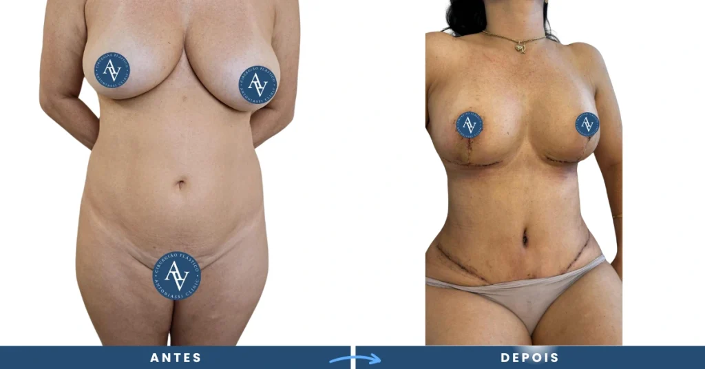 Antes e Depois da Cirurgia Plástica da Barriga a Abdominoplastia e