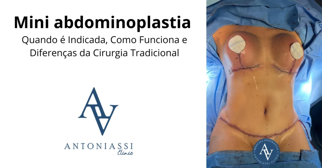 Após cirurgia de Mini Abdominoplastia