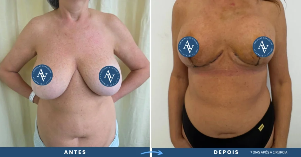 Explante com Mastopexia e Cervicoplastia