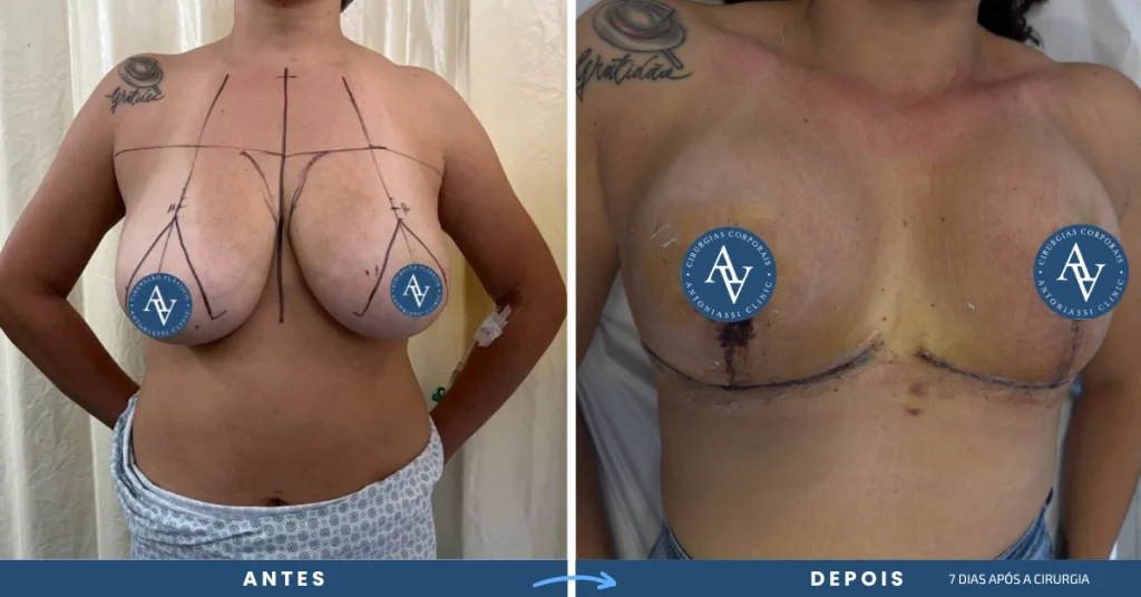 Antes e depois da Mastopexia Sem Prótese