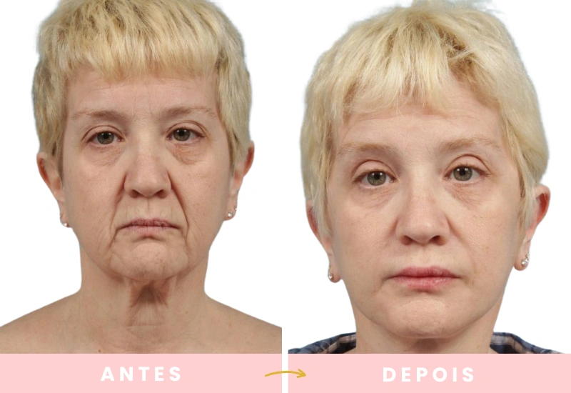 Antes e depois de cirurgias plásticas (1)