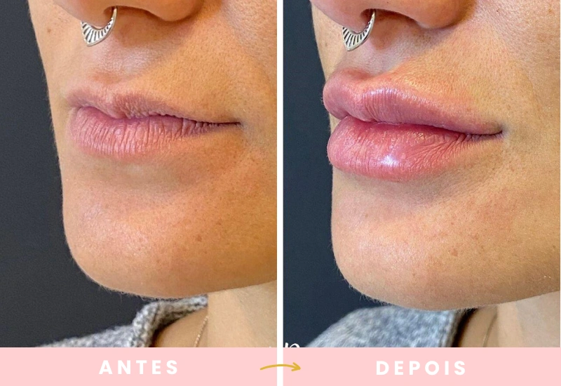 Antes e depois de cirurgias plásticas (10)