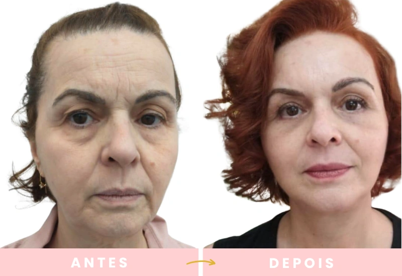 Antes e depois de cirurgias plásticas (2)