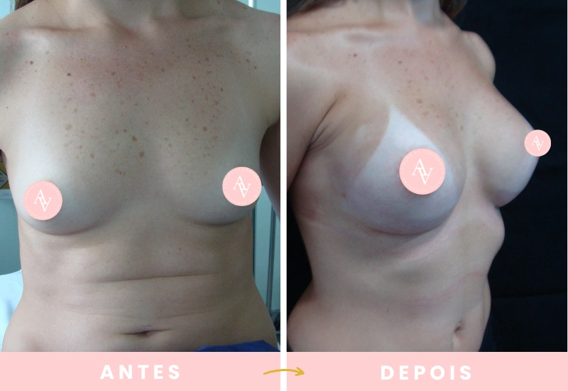 Antes e depois de cirurgias plásticas (4)