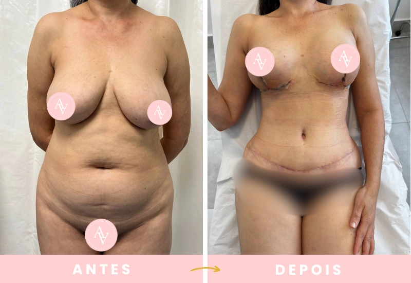 Antes e depois de cirurgias plásticas (6)