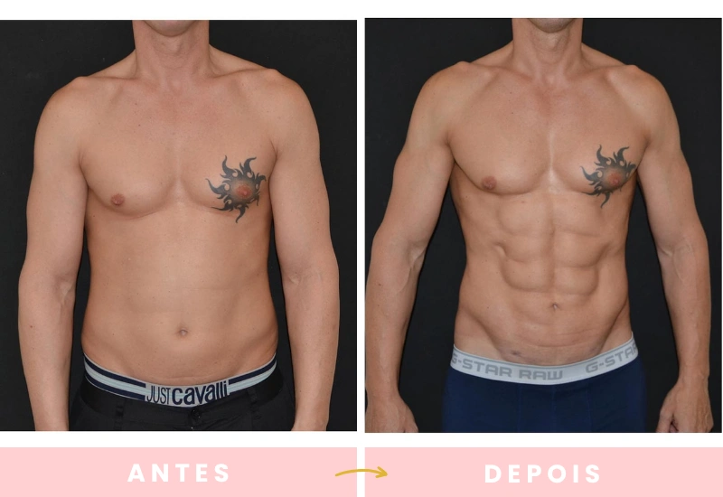 Antes e depois de cirurgias plásticas (7)