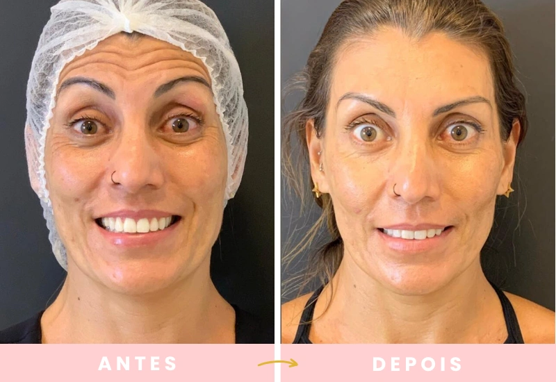 Antes e depois de cirurgias plásticas (9)